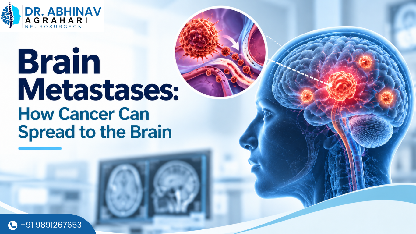 Brain Metastases: How Cancer Can Spread to the Brain